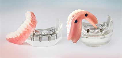 implant-retained dentures