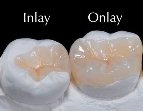 img-inlays